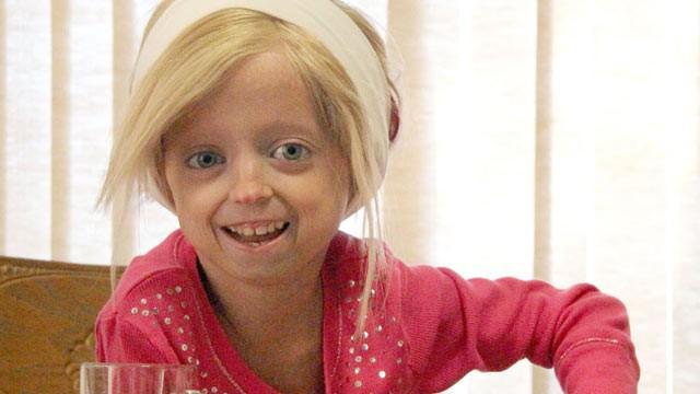 progeria infantile