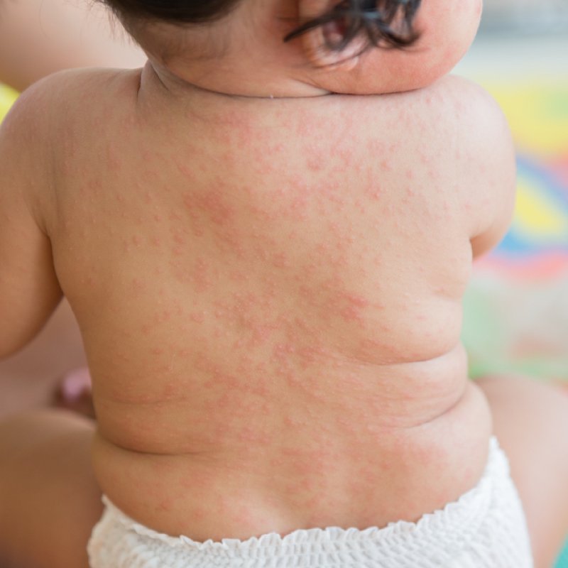 Roseola Kinder Foto und Symptome