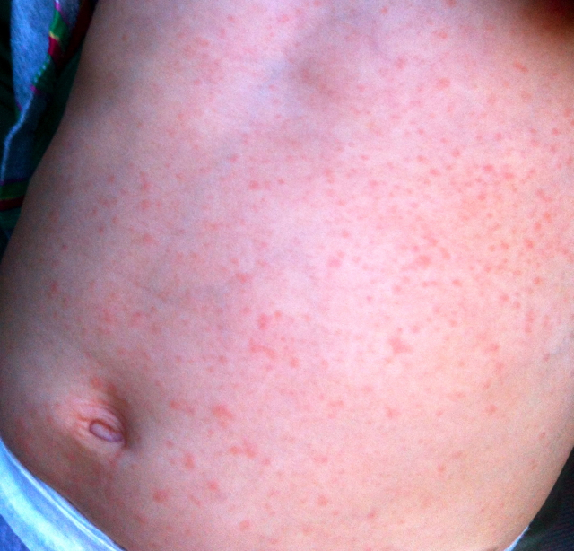 Kinder Roseola