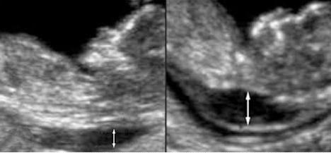 screening av ultraljud och blod i första trimestern