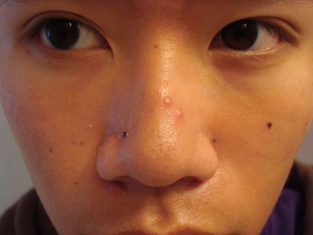 코에 두 개의 여드름 : 징후