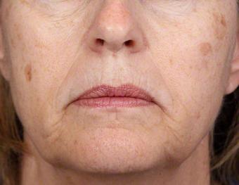 como remover manchas da idade no rosto