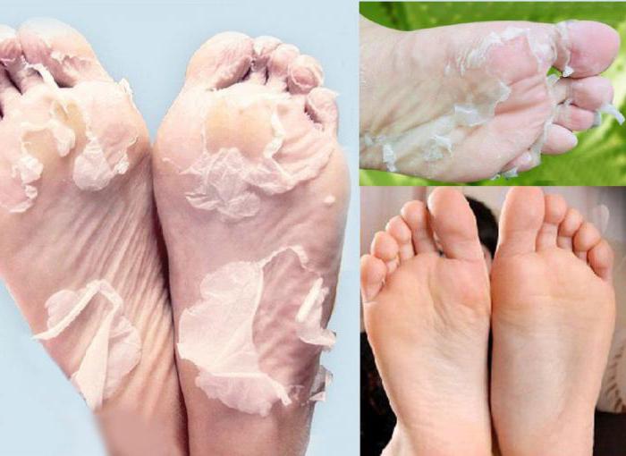 белене на краката с киселини