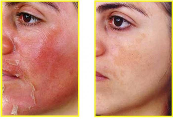 gelbes Retinol-Peeling