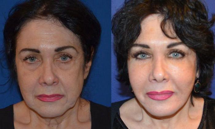 plasma lifting heads reviews before and after photos