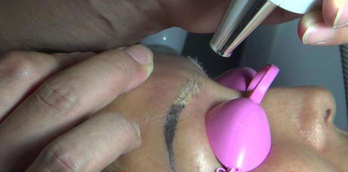 laser wenkbrauw tattoo verwijdering