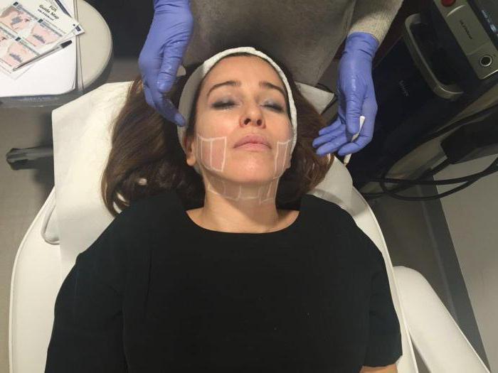  análises de levantamento facial ultra-smas