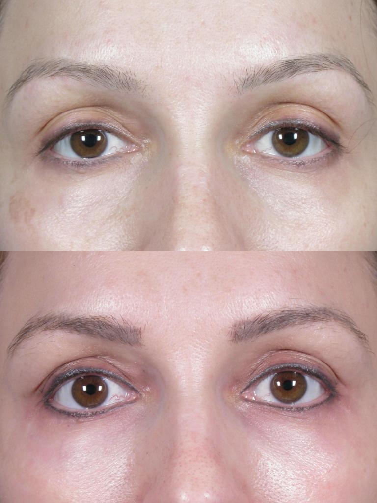 øjenbryn tatovering før og efter proceduren