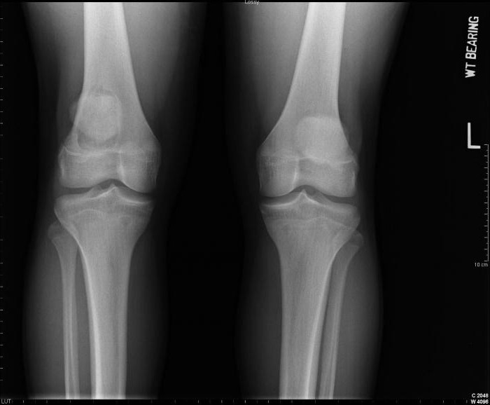 ossos do joelho