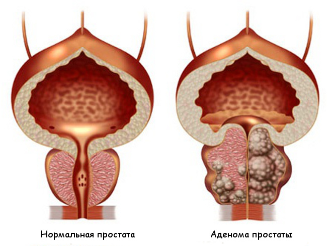 prostatos adenoma vyrų simptomų gydymas