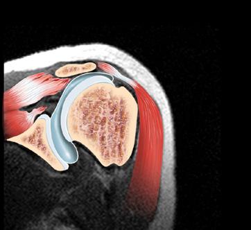 dislocation of an acromioclavicular joint