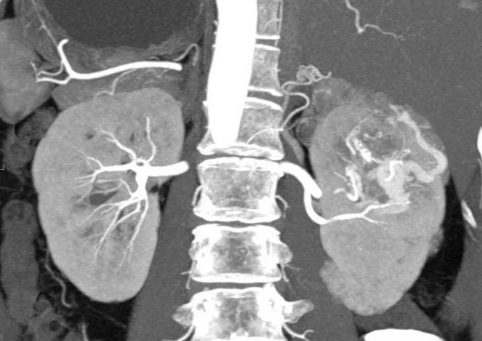 L'angiomiolipoma del rene del rene sinistro e destro è pericoloso