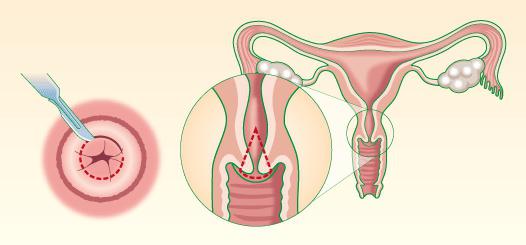 子宮頸部の生検を取得する場所