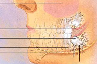 dente del giudizio si arrampica su come alleviare il dolore 