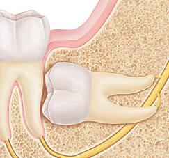 come alleviare il dolore durante la crescita di un dente del giudizio