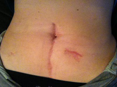 cum arată sutura după operație