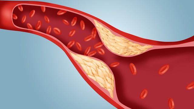 nízká hladina cholesterolu v krvi