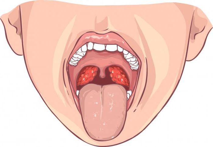 Wat is het verschil tussen angina pectoris en faryngitis en laryngitis