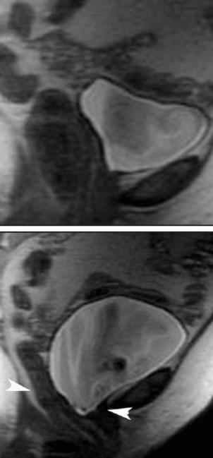 שמראה MRI של האגן אצל נשים עם בעיות פוריות