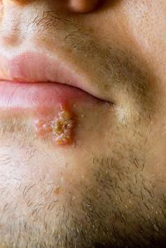 herpes spôsobuje