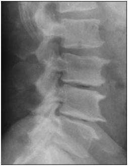 spondylosis of the thoracic spine treatment