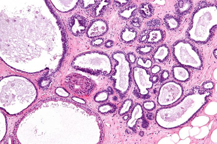 diffuse Brustfibroadenomatose