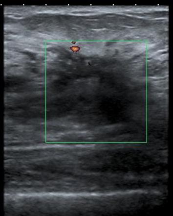 diffuse zystische Brustfibroadenomatose