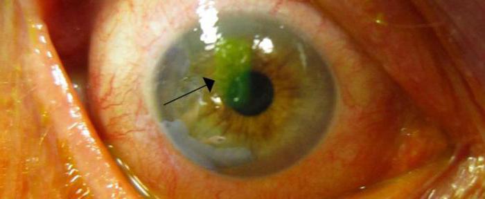 Cornea erosion