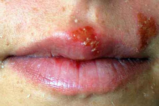 remedio contra el herpes en el labio