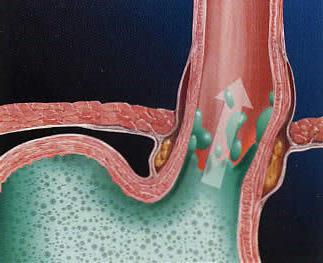 yüksek asitli gastrit ağrı nasıl giderilir