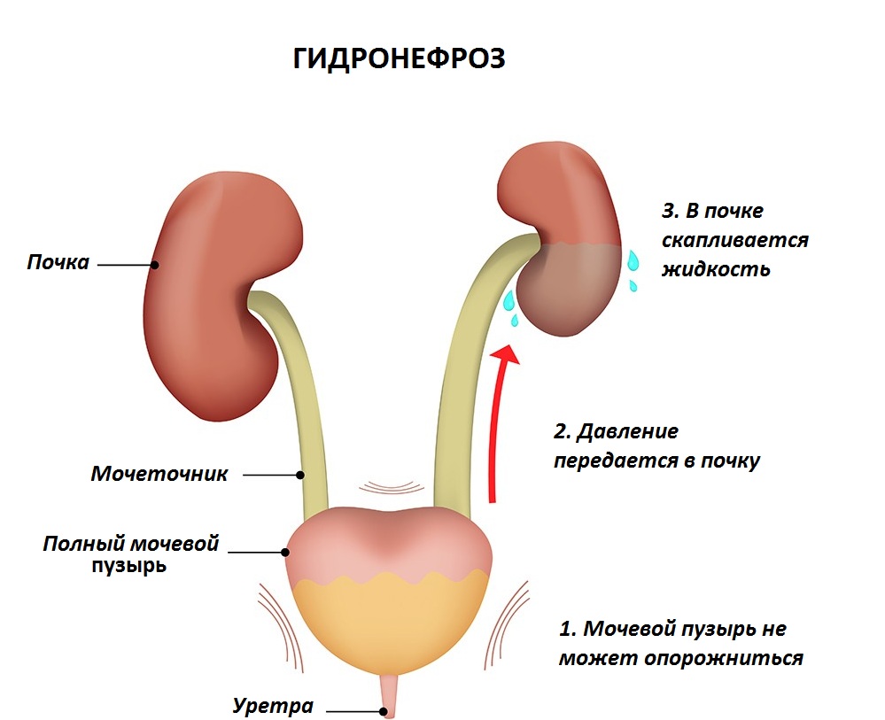 síntomas de hidronefrosis renal