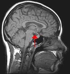 Hypothalamus och hypofysen