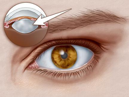 מכשיר "שקע עיניים" לטיפול במחלת הקטרקט