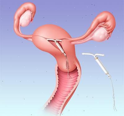 hormonal coil for women 