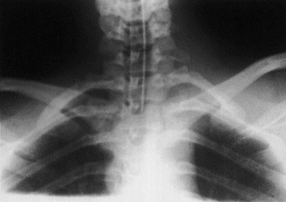 stricăciune articulară sternoclaviculară