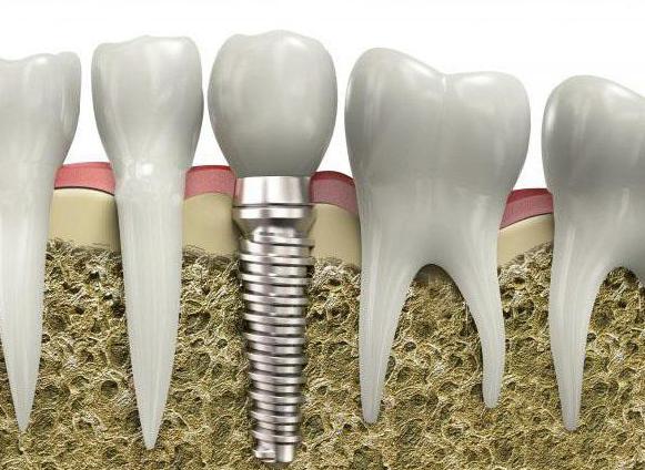 implantare dentară simultană