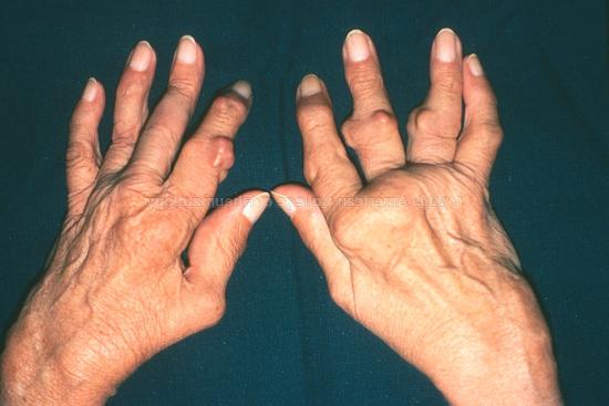 artrite delle articolazioni delle dita