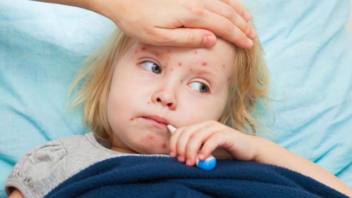 Sintomi di varicella lievi