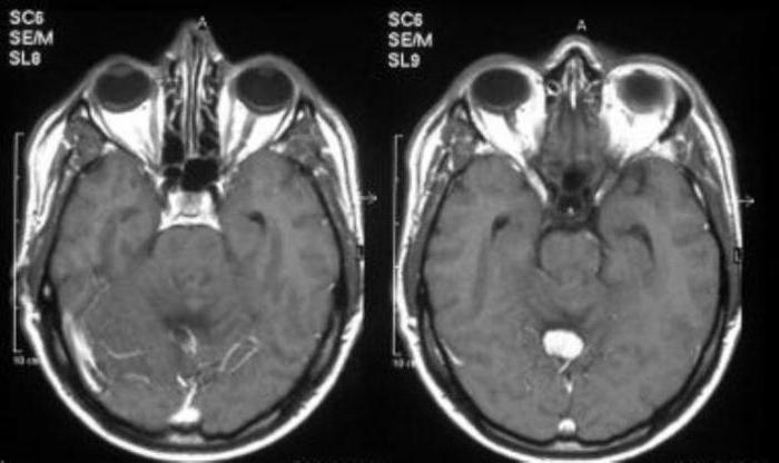 Lindau gipple syndrome 