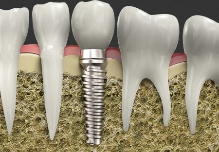 išreikšti dantų implantaciją