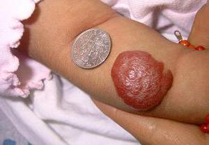 kapillær hæmangiom i huden 