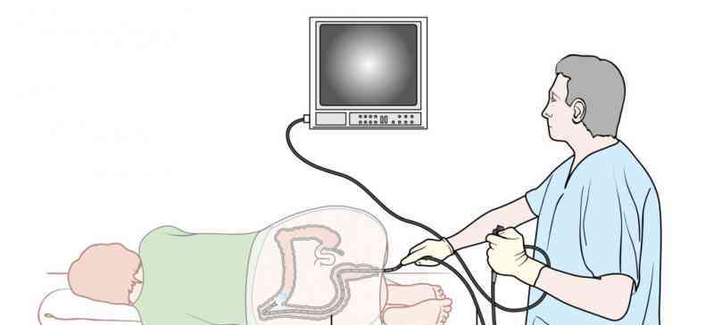 結腸内視鏡検査手順