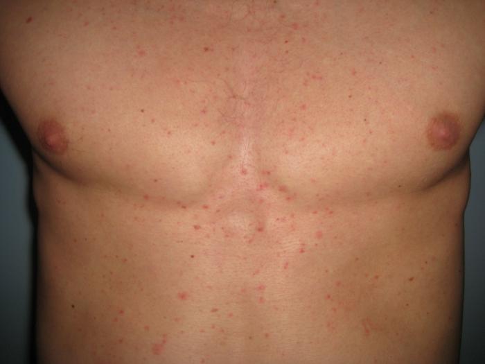Allergiske pletter på brystet