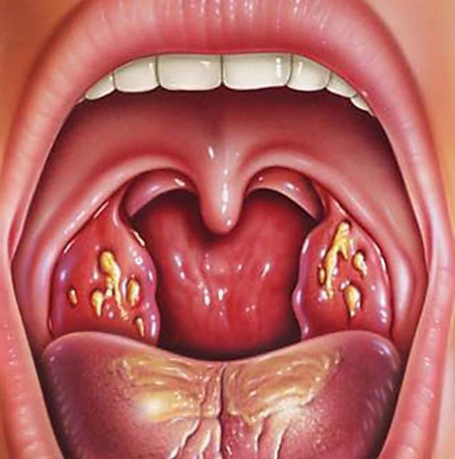 ภาพ lacunar angina ในการรักษาผู้ใหญ่