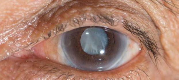 علاج المرحلة الأولية من إعتام عدسة العين