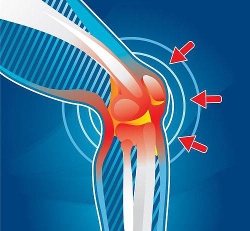 ligamentoza križnih ligamenata koljena 