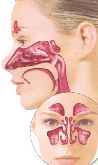 Inflammation of the frontal sinuses