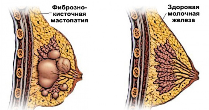 Fibrocistiskā mastopātija