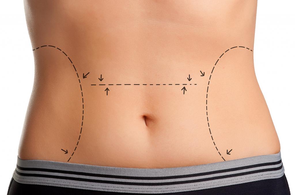 mesoterapia addominale