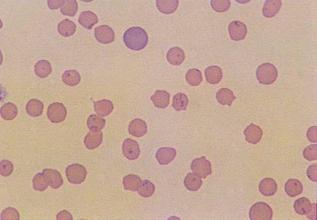 mycoplasmosis in pregnancy